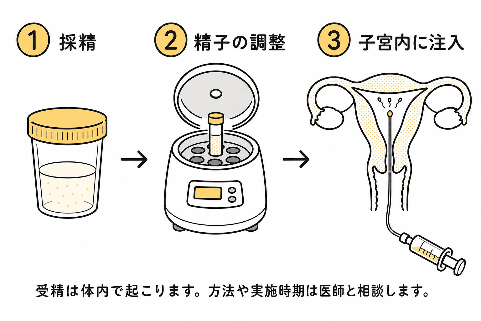 人工授精で採精と精子の調整を行い、細いカテーテルで子宮内に注入する流れ
